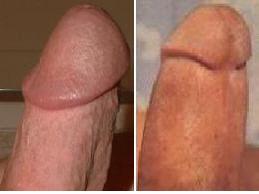 Penis uncut cut Cut v.s